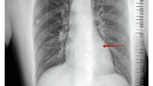 دخل المستشفى لسبب عادي.. فاكتشف الأطباء شيئاً في قلبه